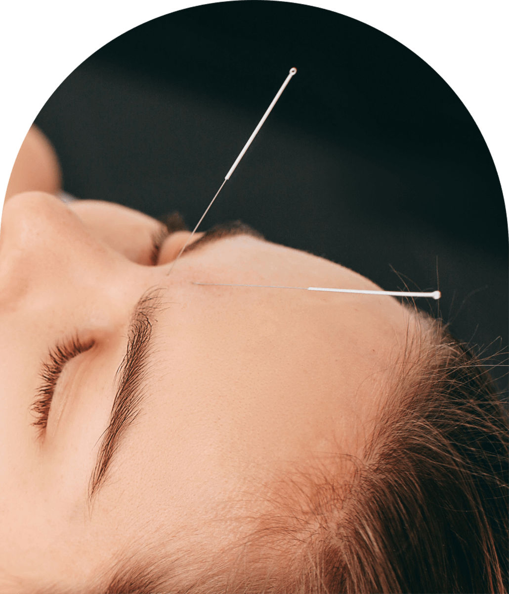 Facial Acupunture