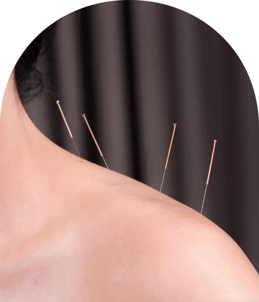 Korean Acupunture
